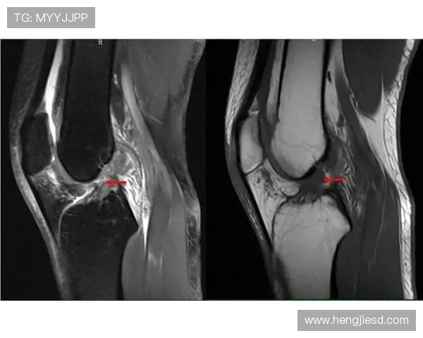 罗德里戈2023年十字韧带部分撕裂保守治疗 罗德里戈2023年十字韧带部分撕裂保守治疗